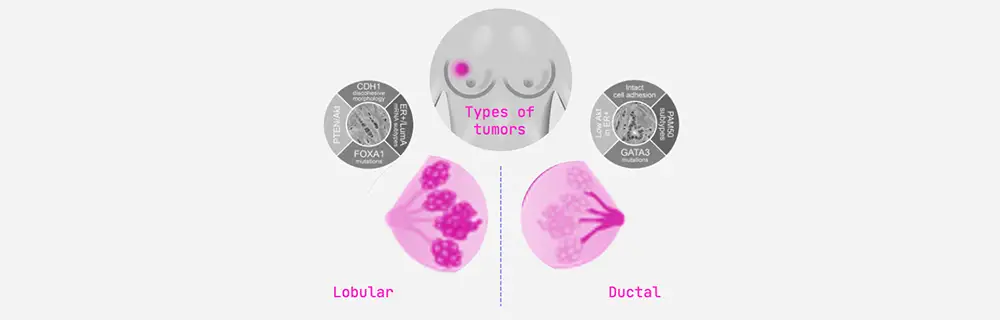 The two types of breast cancer: Lobular and ductal